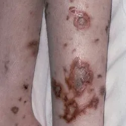 simptome Sepsis, cauze si tratament, prognosticul