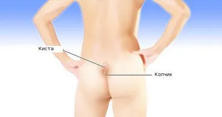 Bump asupra cauzelor coccis ale consecințelor posibile