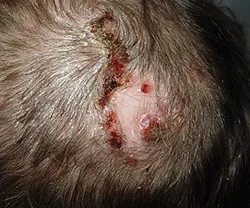 Sicoza - cauze, simptome, diagnostic și tratament