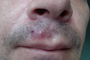 forme Sicoza, simptome, prevenire, tratament, complicații, prognostic