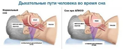 Simptomele de apnee de somn - cum să nu moară în somn (noapte) Simptomele de apnee de somn - cum să nu moară în somn