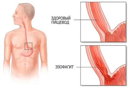 Simptomele si tratamentul esofagului esofagita, prognostic și diagnostic, dieta in boala
