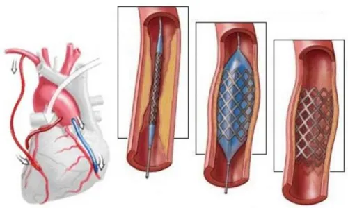 Heart nave chirurgie de by-pass ce este, cât de multe vii (by-pass) Heart nave chirurgie de by-pass ce este, cât de mulți trăiesc