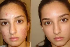 Tonic pentru ten gras - fata