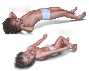 Simptomele sclerozei tuberoase si tratament