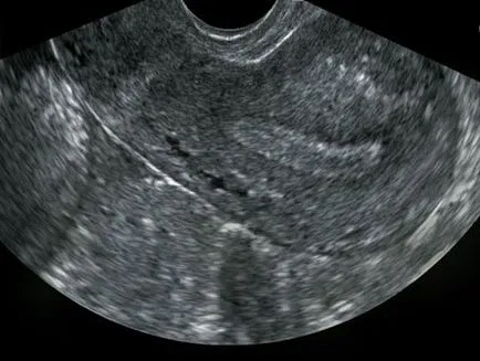 Uzi endometru se poate vedea daca endometrioza, polipi, cancer, endometrita