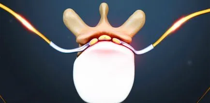 cervicalgia vertebrogena