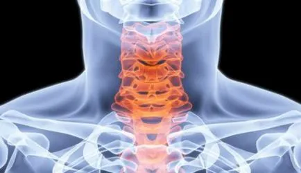 cervicalgia vertebrogena