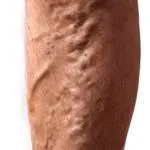 Toate venele picioarelor varicoase si tratamentul acesteia (ar trebui să fie aplicate pe piele) Toate venelor varicoase ale picioarelor si tratamentul acesteia