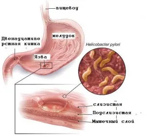 ulcer gastric și boala ulcer duodenal simptome, tratament, cauze, (stomac) ulcerul gastric si ulcerul duodenal simptome, tratament, cauze,