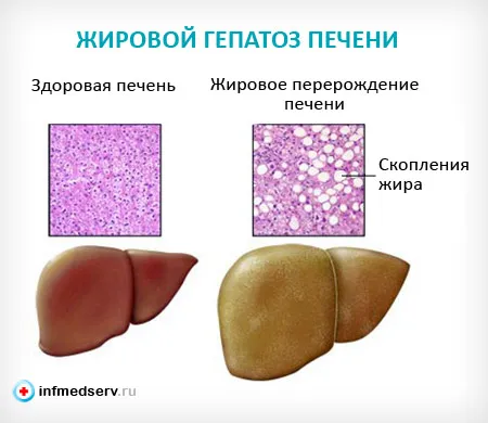 Cauzele steatozei hepatice si simptome (steatoză) Cauzele steatozei si simptome ale ficatului