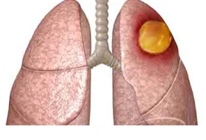 Lung abcesele ce este