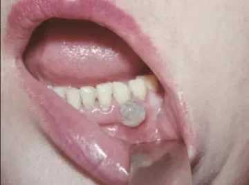 Ce este un abces al gingiilor