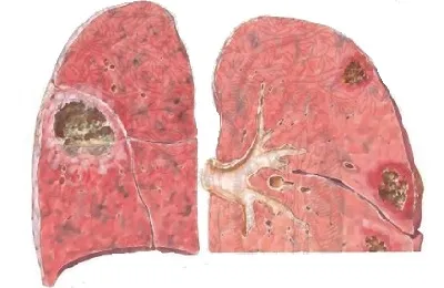 Lung abcesele ce este