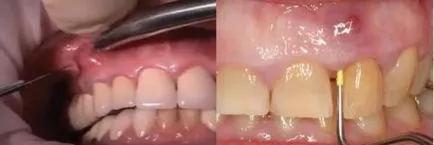 Ce este un abces al gingiilor
