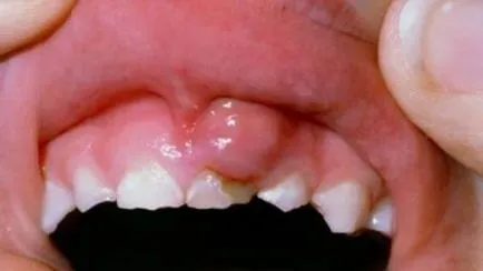 Ce este un abces al gingiilor