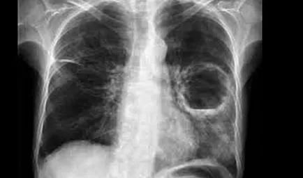 Lung abcesele ce este