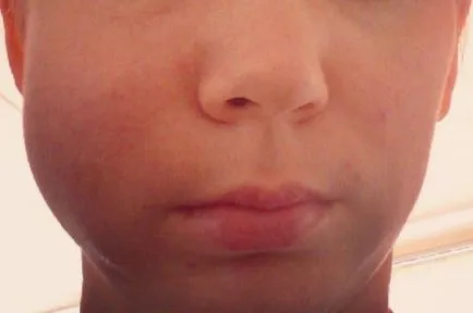 Ce este un abces al gingiilor