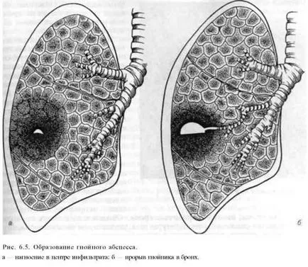 Lung abcesele ce este