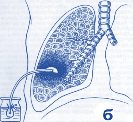 Lung abcesele ce este