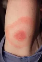 Alergică la mușcătura de musculițe Alergică la mușcătura de musculițe