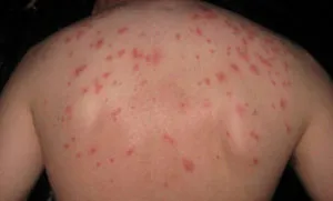 Alergică la mușcătura de musculițe Alergică la mușcătura de musculițe