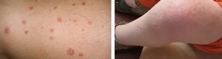 Dermatite ce să facă Dermatite ce să facă