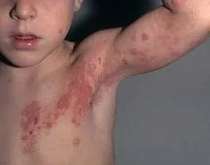 Cum de a vindeca herpesul la copii