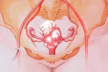 Ce se va întâmpla dacă există fibroame