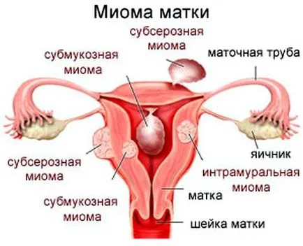 Ce se va întâmpla dacă există fibroame