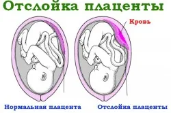 Ce ar trebui să fac în cazul în care durerea în abdomen Ce ar trebui să fac în cazul în care durerea în abdomen
