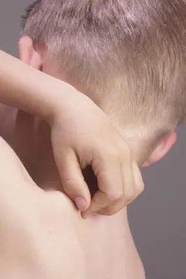 Alergică la mușcătura de musculițe Alergică la mușcătura de musculițe