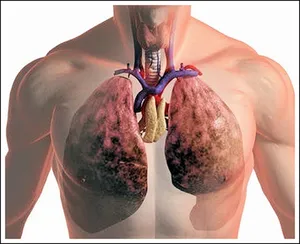 Ce este tuberculoma pulmonar Ce este tuberculoma pulmonar