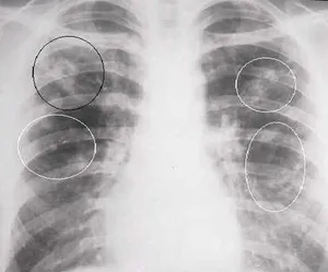 Ce este tuberculoma pulmonar Ce este tuberculoma pulmonar