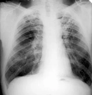 Ce este tuberculoma pulmonar Ce este tuberculoma pulmonar