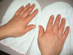 Dermatite ce să facă