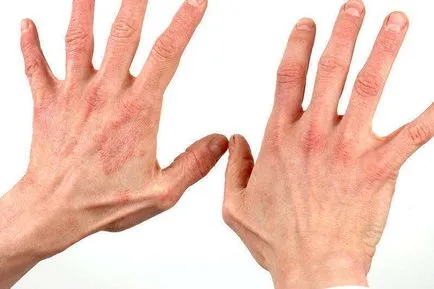 Dermatite ce să facă