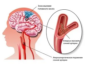 Tratamentul encefalopatiei cerebral Tratamentul encefalopatiei cerebral