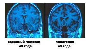 Tratamentul encefalopatiei cerebral Tratamentul encefalopatiei cerebral