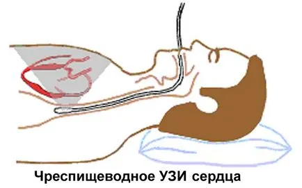 Ce este o ecocardiografie