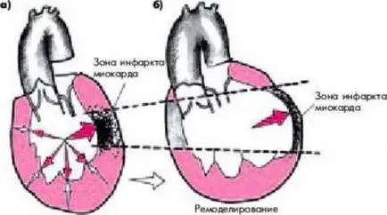 Tratamentul de hipertrofie a ventriculului stâng al inimii