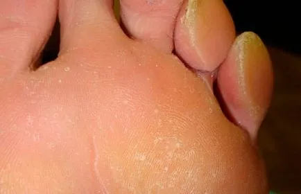 Hiperhidroza opri