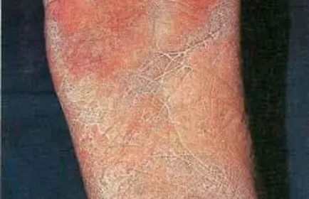 Hiperhidroza opri