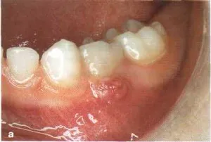Ce este un abces al gingiilor Ce este un abces al gingiilor