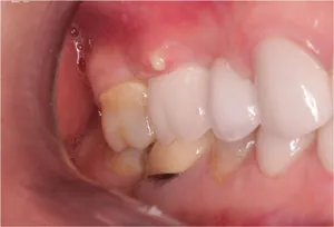 Ce este un abces al gingiilor Ce este un abces al gingiilor