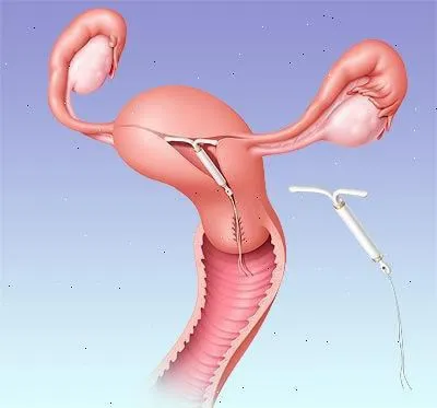 Intrauterine spirală Hormonale