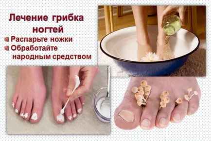 Ce se poate vindeca ciuperca unghiilor
