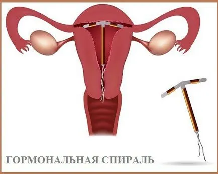 Intrauterine spirală Hormonale