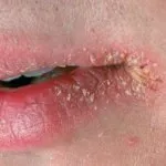 Impetigo este ceea ce este Impetigo este ceea ce este