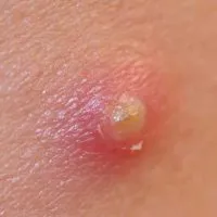 Impetigo este ceea ce este Impetigo este ceea ce este